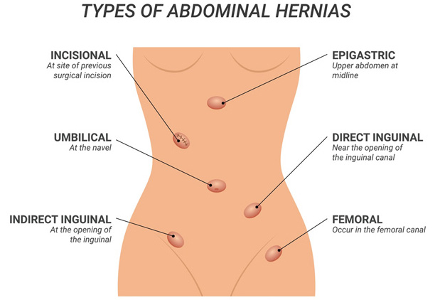 HerniaBodyImage06-01-23web